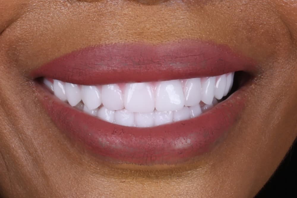 After smile transformation case 1