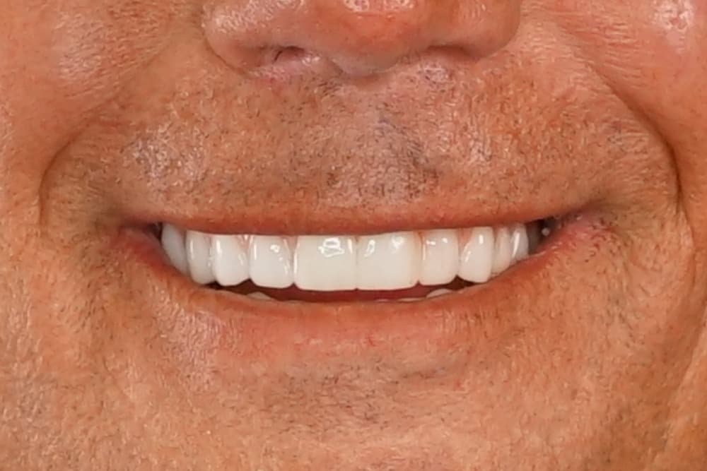 After smile transformation case 2