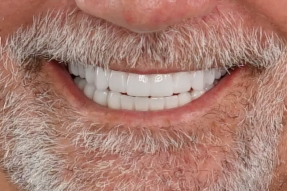 After smile transformation case 3
