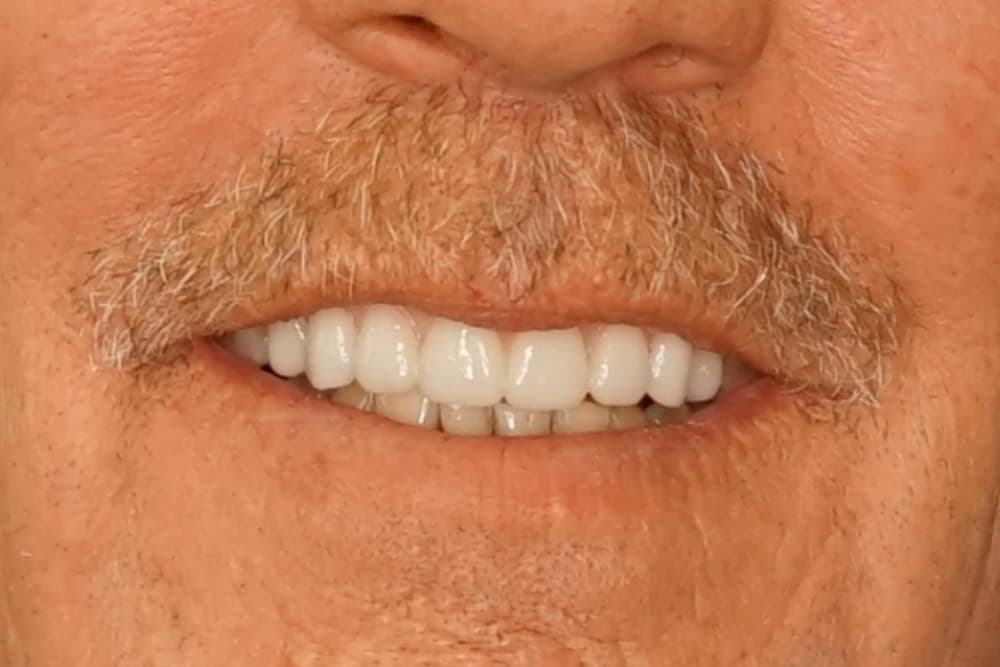 After smile transformation case 4