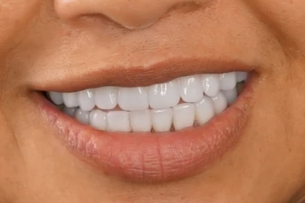 After smile transformation case 5