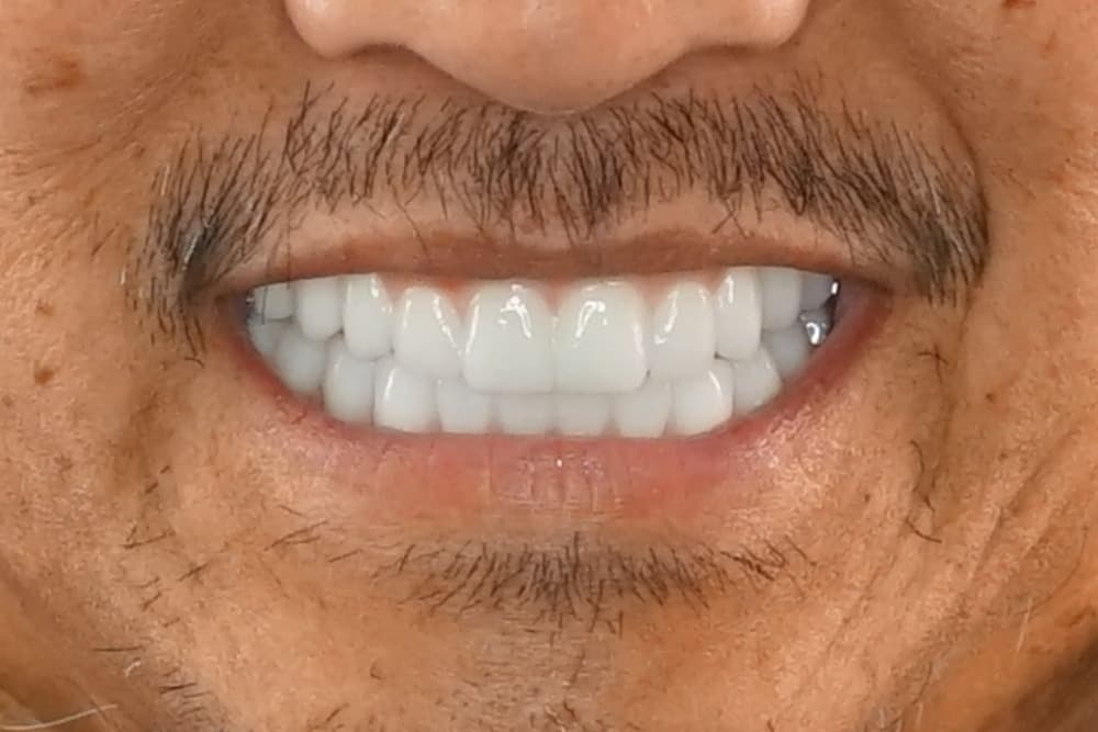 After smile transformation case 6