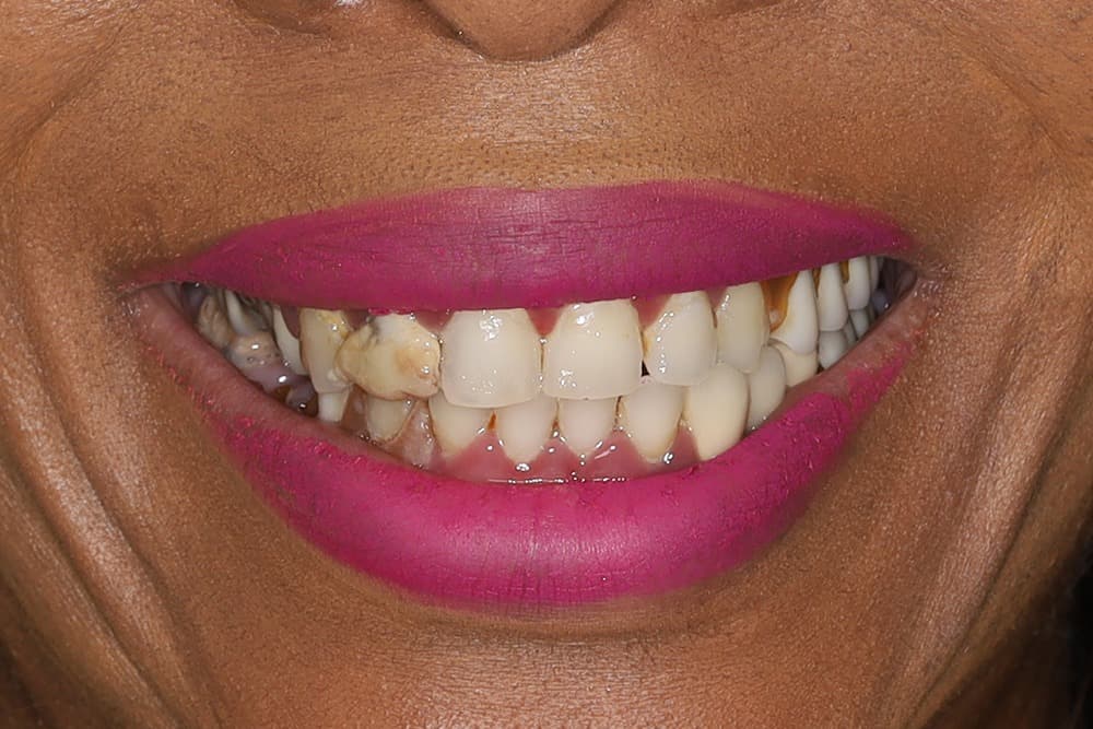 Before smile transformation case 1