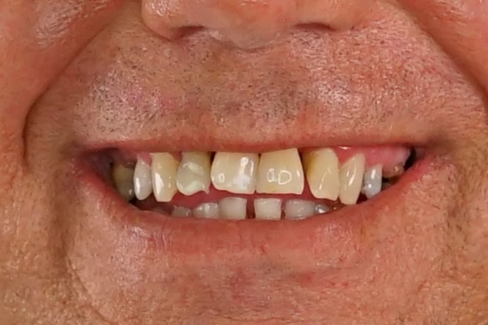 Before smile transformation case 2