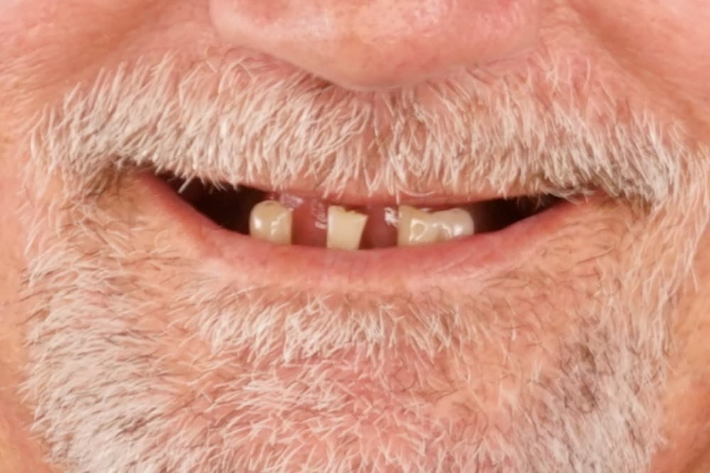 Before smile transformation case 3