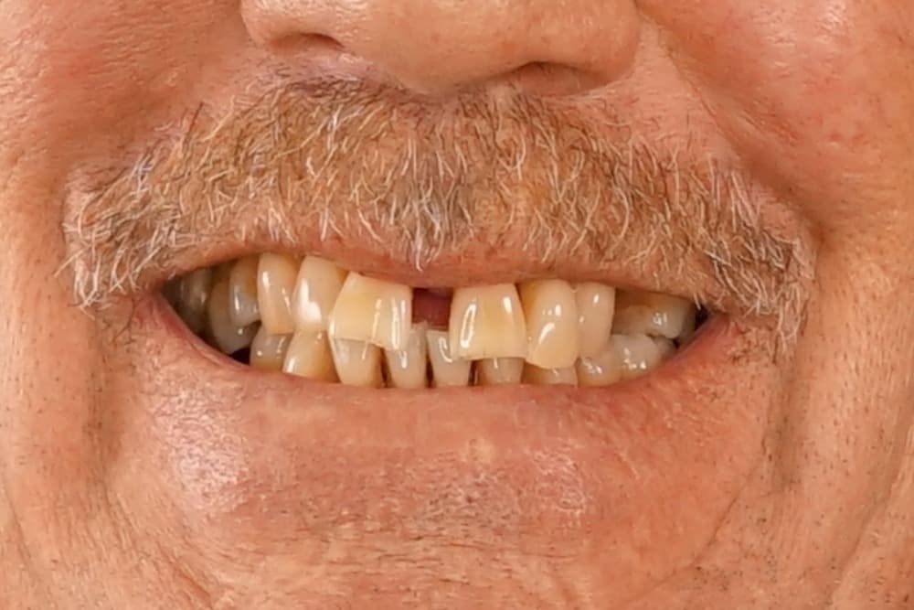 Before smile transformation case 4