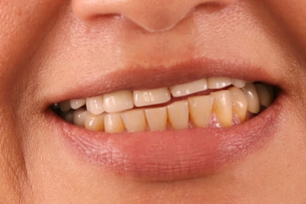 Before smile transformation case 5