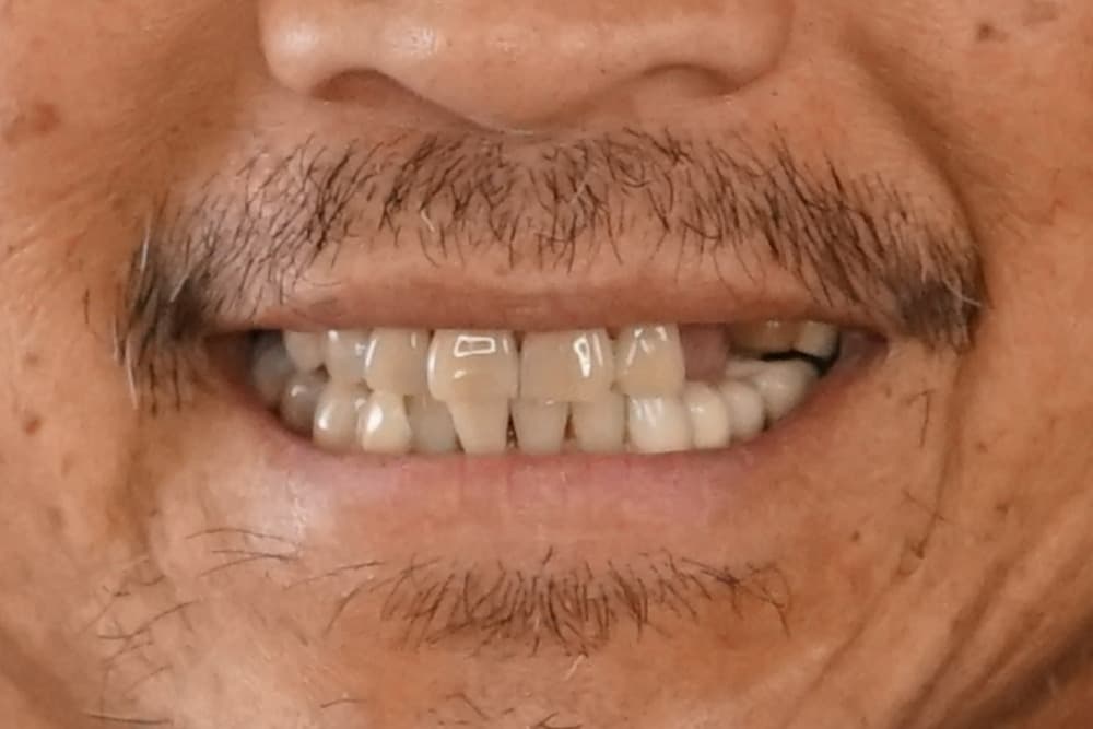 Before smile transformation case 6