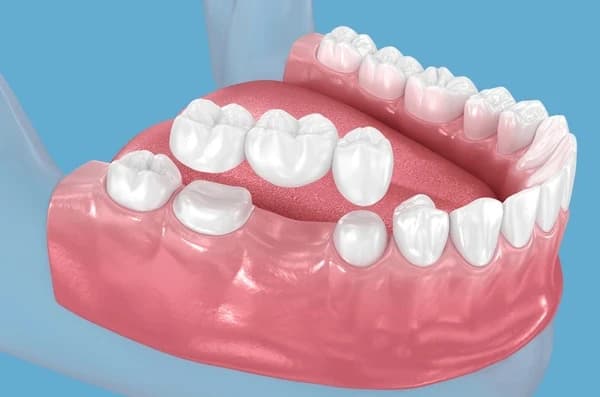 Dental bridge replacing missing teeth at Million Dollar Smile in San Diego, CA