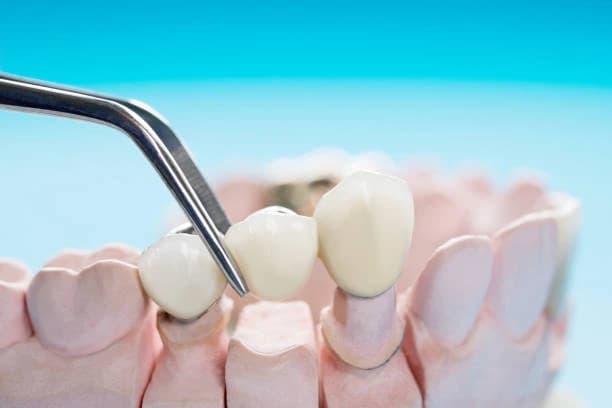 Custom porcelain dental crown restoration at Million Dollar Smile in San Diego, CA