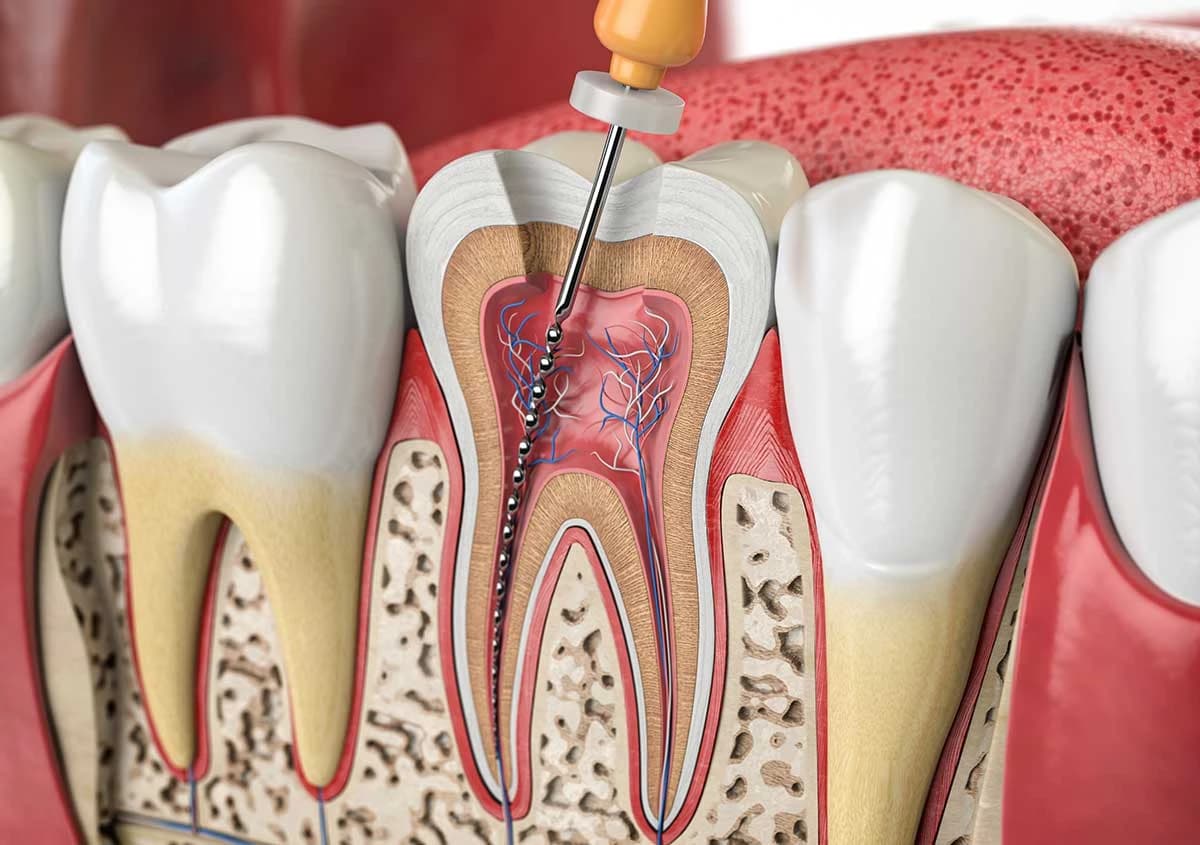 Gentle, pain-free root canal treatment at Million Dollar Smile in San Diego, CA