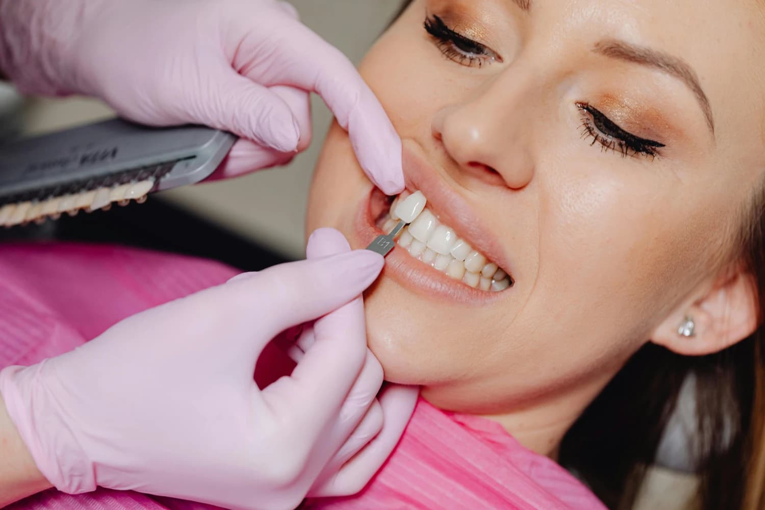 Cosmetic dental bonding smile results at Million Dollar Smile in San Diego, CA