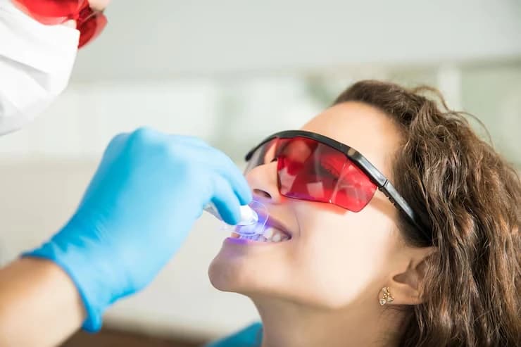 Professional teeth whitening results at Million Dollar Smile in San Diego, CA